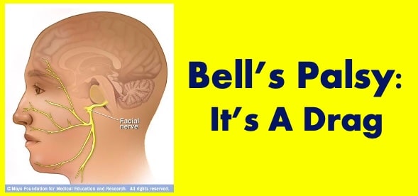 Palsy apa itu bell Fisioterapi Bell’s