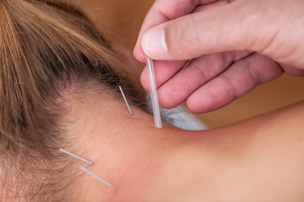 A physical therapist performs dry needling on a patients neck to alleviate muscle tension